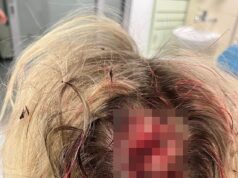 Enfermeira ‘atacada por migrante afegão em tumulto com pés de cabra’ revela que foi ‘espancada quase até a morte’ ao revelar ferimentos horríveis infligidos a ela