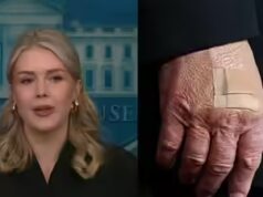 Karoline Leavitt revela porque há bandagens na mão de Trump: ‘O presidente está literalmente…’