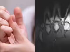 Estalar os nós dos dedos os torna maiores? Cientistas finalmente resolvem mito de longa knowledge