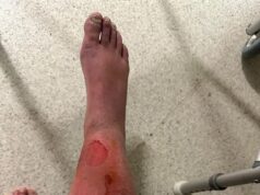 O horror das férias quando uma pequena picada de água-viva deixa a mãe de Perth à beira da amputação: ‘Meu pé começou a ficar preto’