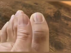 Linhas pretas fracas nas unhas: inofensivas ou sinal de câncer de pele agressivo? Postagem no Reddit se torna viral